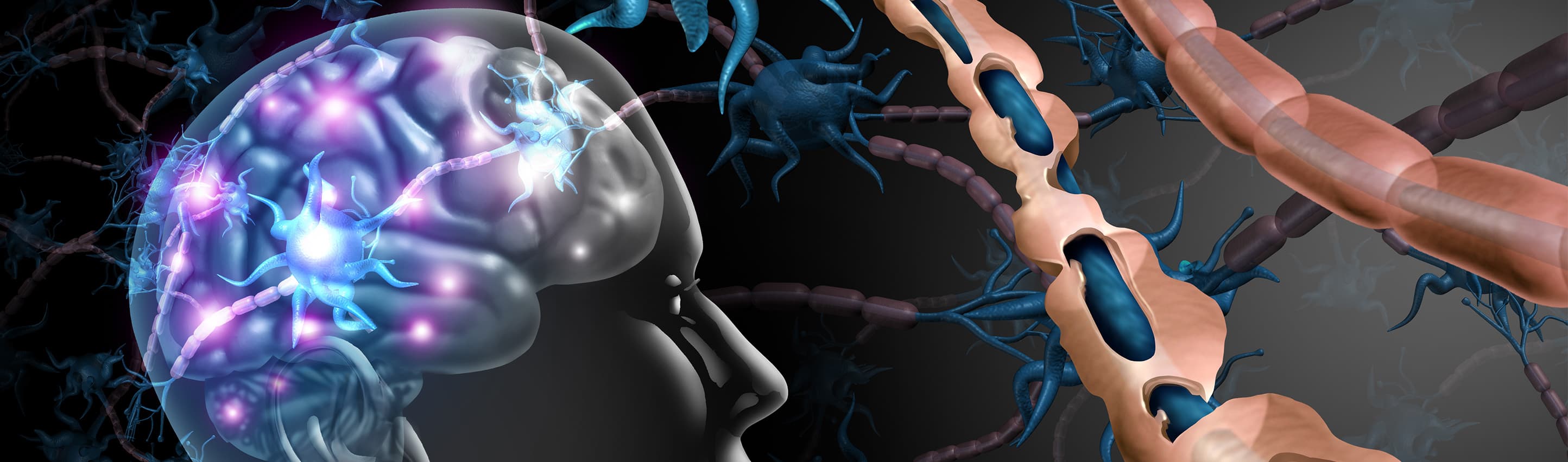 Multiple sclerosis