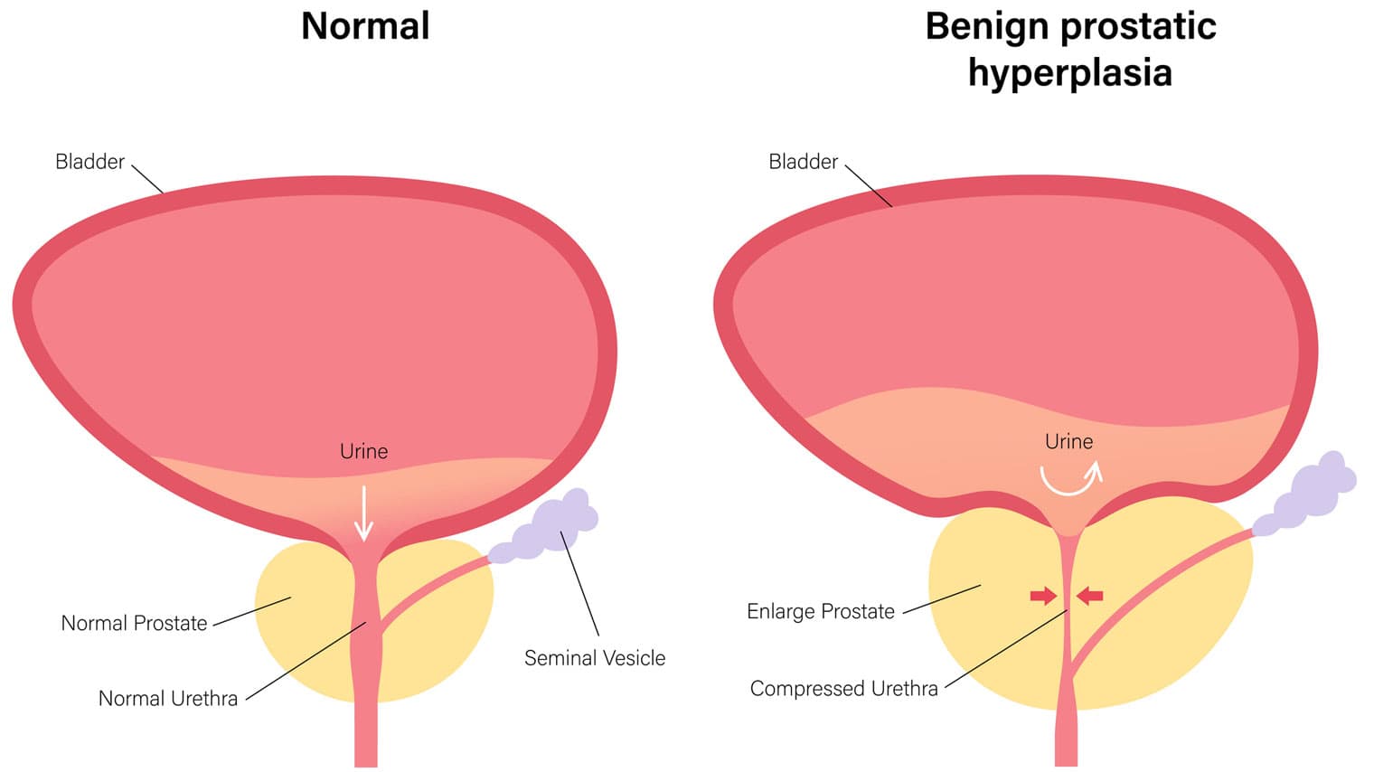 BPH illustration