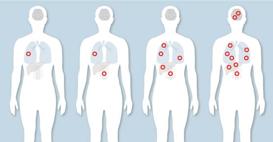spectrum of cancer spread: localized, oligometastatic, widely diffuse metastatic disease