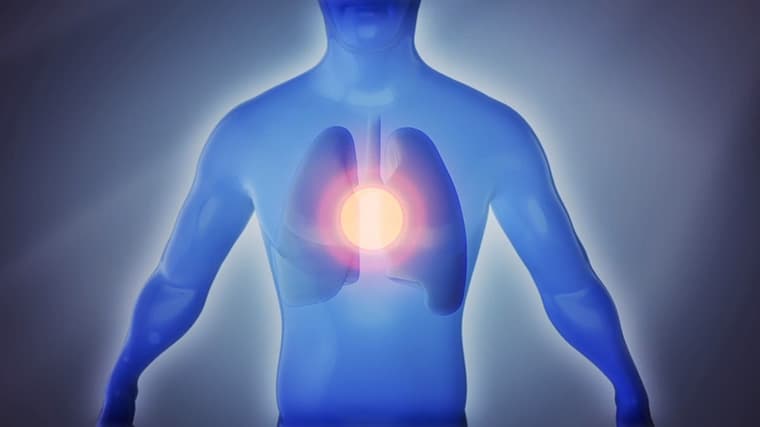 Advanced Emphysema